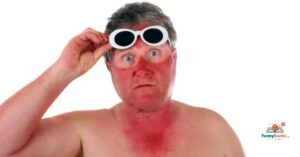 Sunburn Puns